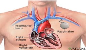 Pacemaker Check in Pune 